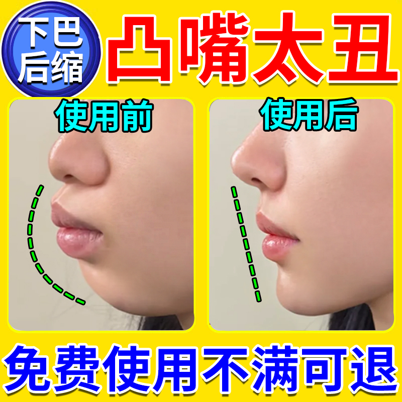 腺样体肥大儿童贴面容矫正器