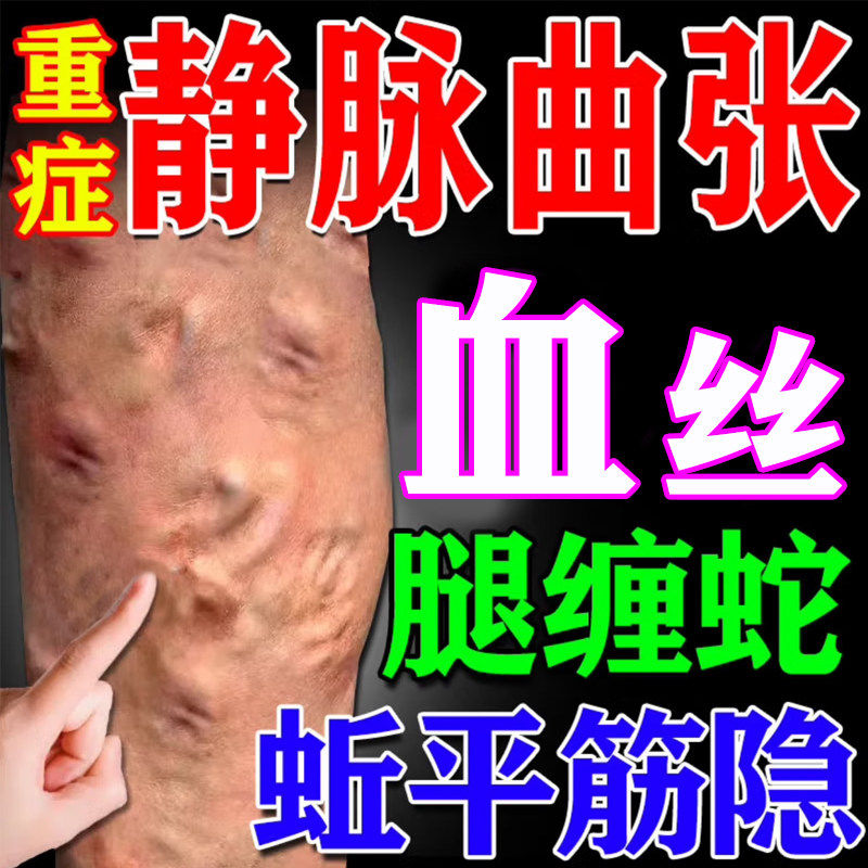 李时珍静脉曲张膏凝胶官方正品青筋凸起精索脉舒防蚯蚓腿血丝明显