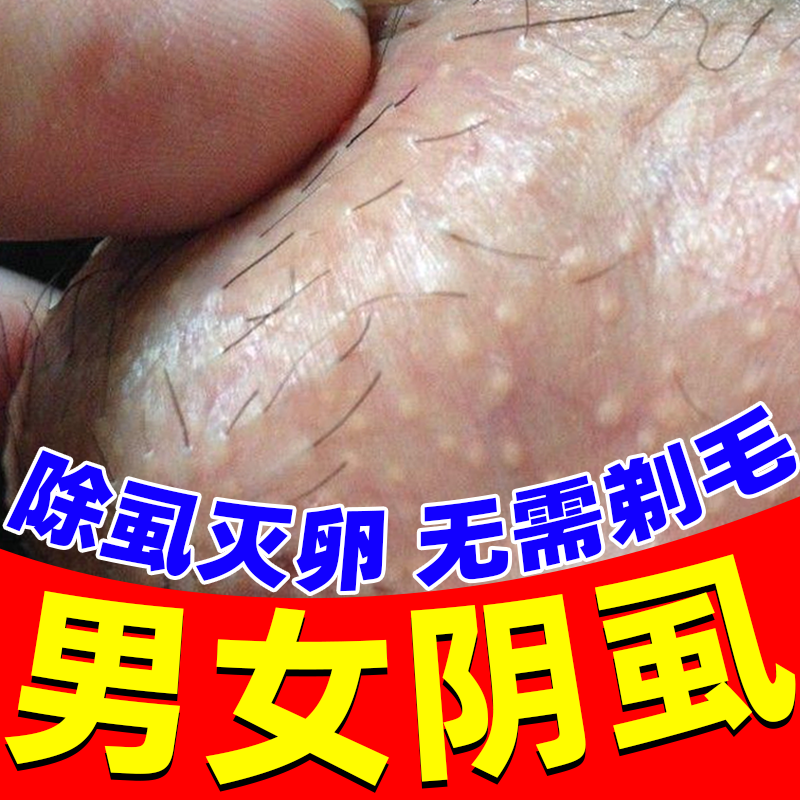 阴虱子专用药百部酊灭阴虱喷剂虫卵双杀男私处灭阴虱成人正品专用