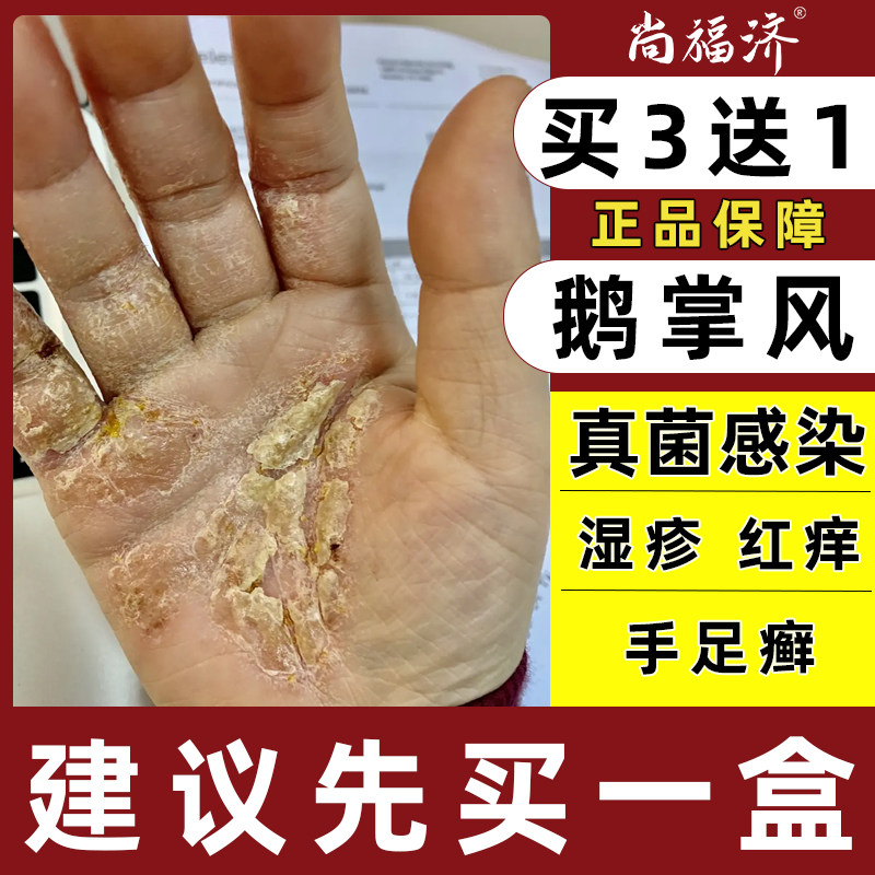 手癣膏脱皮干裂真菌感染手上去小水泡鹅掌风手足癣湿疹止痒