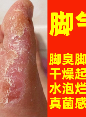 烂脚丫专用脚趾缝脱皮脚痒糜烂脚气止痒杀菌喷雾脚癣水泡真菌感染