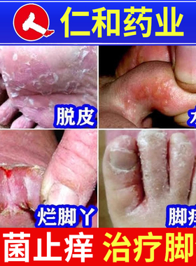 仁和治脚气药膏止痒脱皮杀菌真菌感染水泡型治疗烂脚丫足癣专用bt