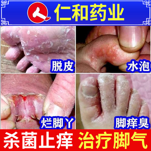 【仁和】硝酸咪康唑乳膏2%*20g*1支/盒