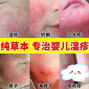 武甸制药炉甘石湿疹止痒根去顽固皮炎婴儿童宝宝专用抑菌中药乳膏