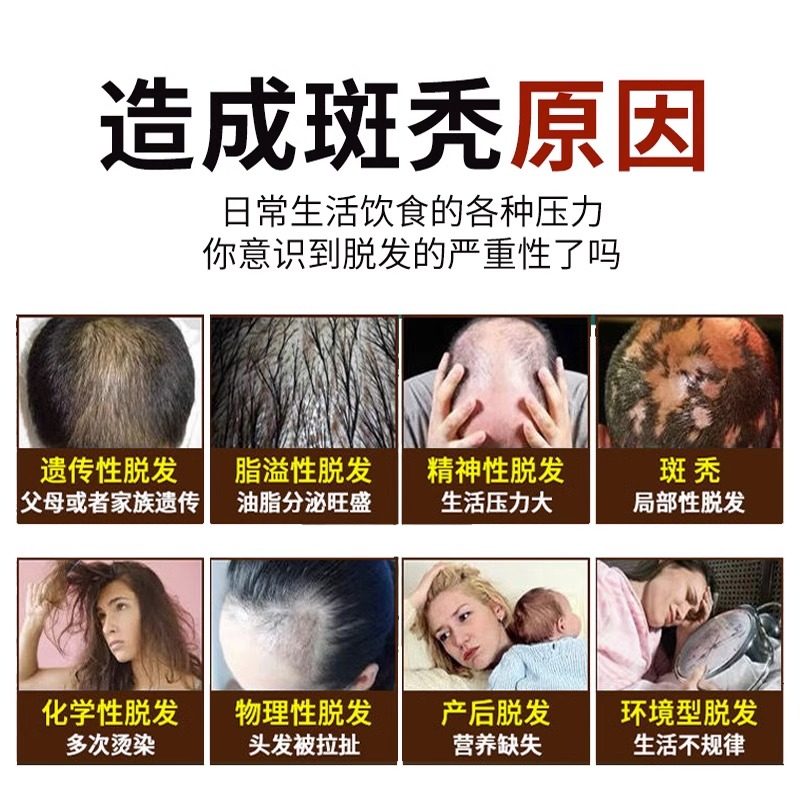 鬼剃头药斑秃治疗药地中海米诺地尔酊男女性防脱发生发育发精华液