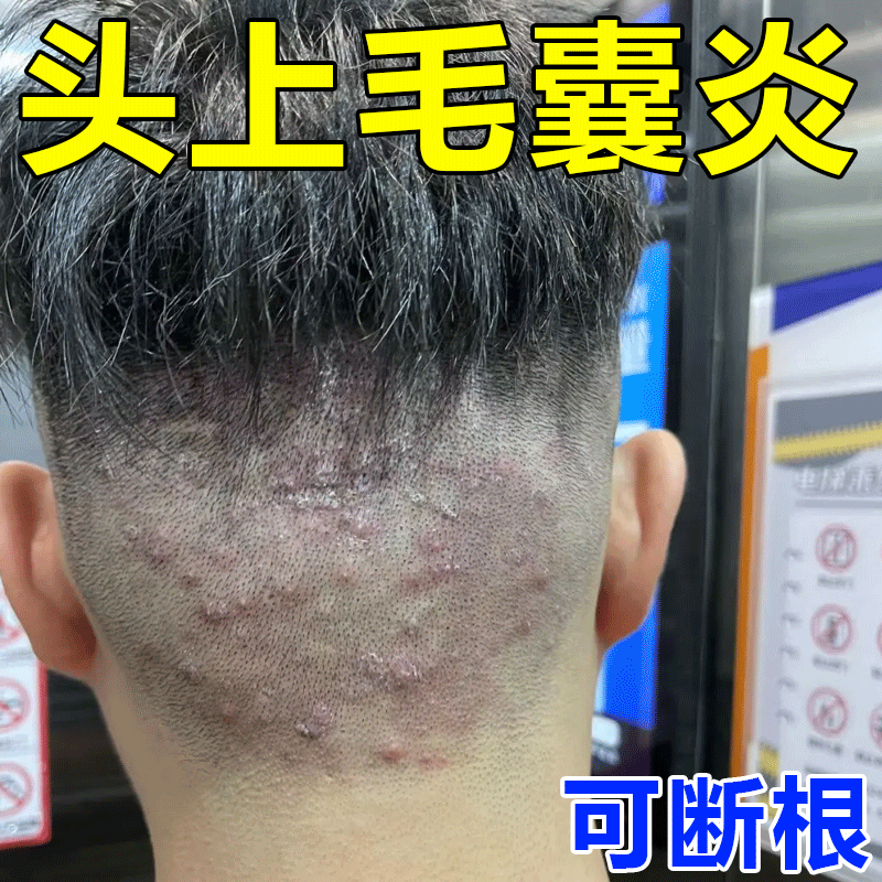 头上长痘痘脓包疙瘩头癣毛囊炎脓疮毛囊发炎堵塞抑菌止痒消炎乳膏