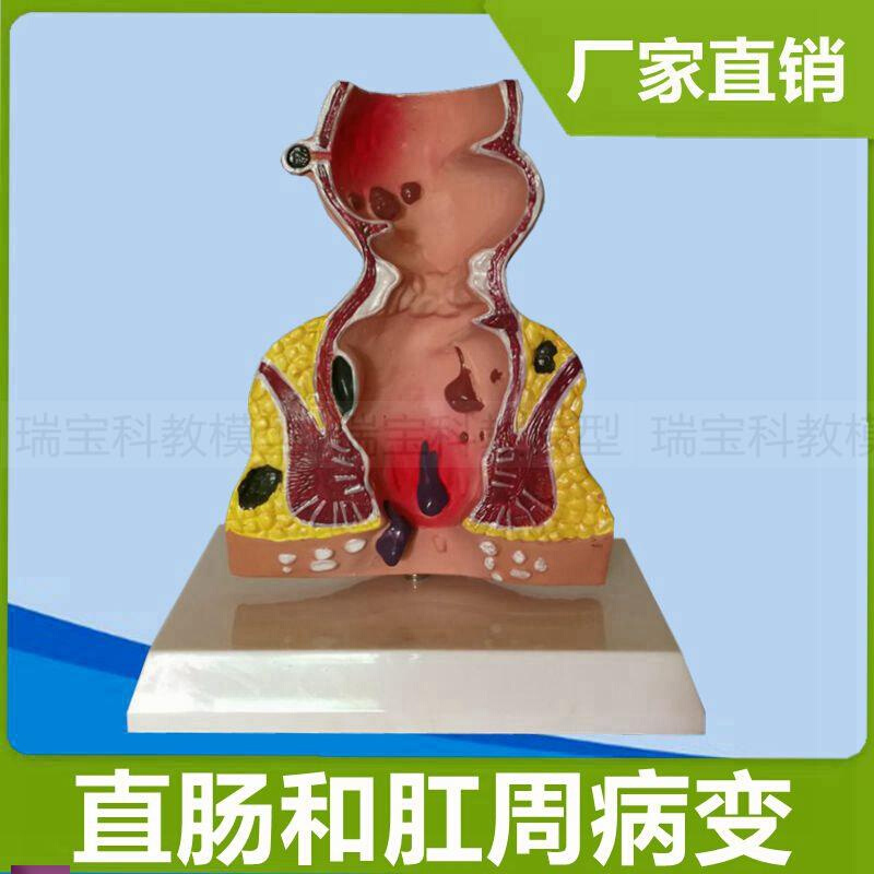 人体直肠模型g肛管裂开痔内外突出瘘管消化道结肠大肠医患病理沟