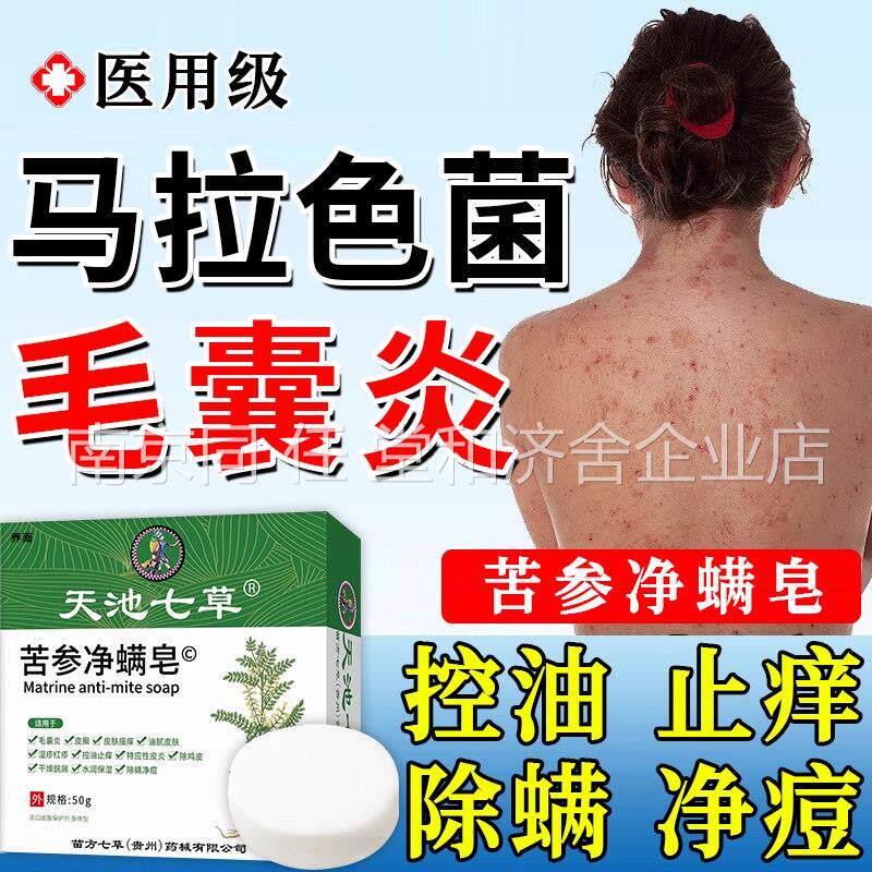背上长痘痘毛囊炎沐浴露除螨祛痘痒硫色磺香皂马拉菌药真菌感染UU