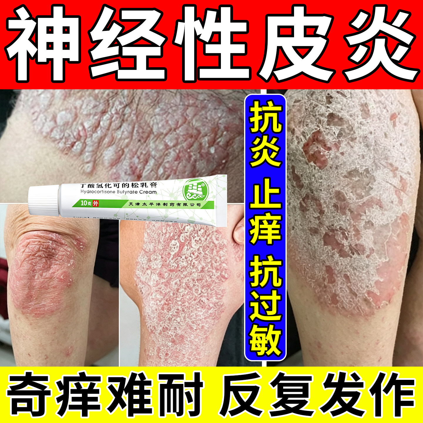丁酸氢化可的松乳膏治神经性皮炎药膏皮炎瘙痒湿疹止痒膏抗菌消炎
