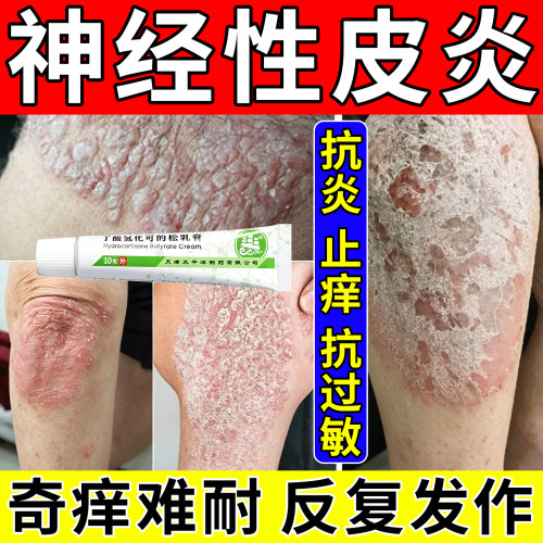 抗炎止痒抗过敏治疗神经性皮炎