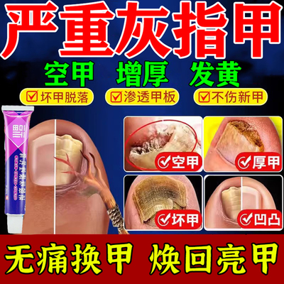 灰指甲专用药甲沟炎手脚指甲真菌感染药旗舰店正品硝酸咪康唑软膏