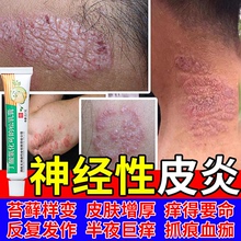 皮肤癣痒专用药膏止痒抑菌治疗神经性皮炎皮肤病癣藓湿疹真菌感染