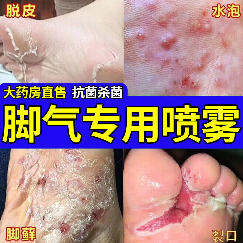 脚气喷雾治疗脚气止痒脱皮杀菌脚气烂脚丫药脱皮糜烂脚趾缝烂痒
