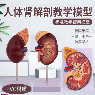 人体肾模型肾解剖自然大人体肾脏模型肾脏演示V病变肾内脏模