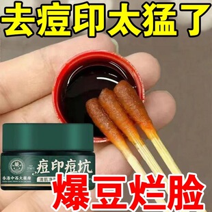 祛痘膏痘印痘坑去红肿痘学生非修复淡化痘疤男生女旗舰店官方正品