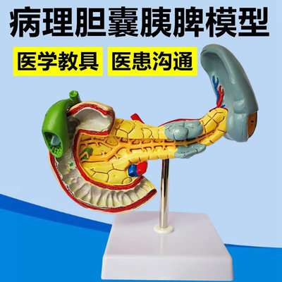 病理肝胆模型 胰腺脾脏结构内分泌消化道十二指肠结实血医患临床