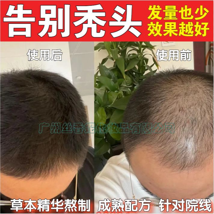 防脱育发精华液增长发密发育发何首乌固发生发液毛囊修复液生发液