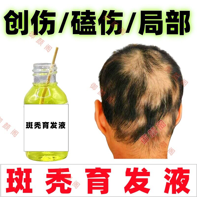 压力斑块状掉头发后脑勺掉头发斑秃鬼剃头发防脱脂溢性秃头育发液