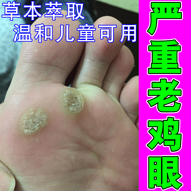 鸡眼药水治鸡眼脚底长硬疙瘩走路疼手上足部长硬茧老厚死皮软化药