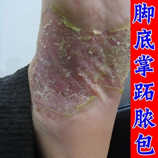掌趾脓疱病掌跖角化症脚底蜕皮干裂红斑有烧灼感皮肤角化过度膏
