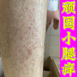 顽固小腿痒起红疙瘩换季腿过敏痒起小红点红疹越抓越痒起热疹子