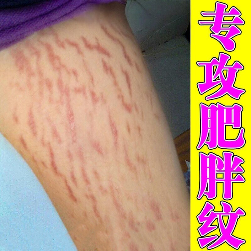 去肥胖纹生长纹修复霜除全身生长膨胀纹预防妊娠纹淡化祛除疤膏