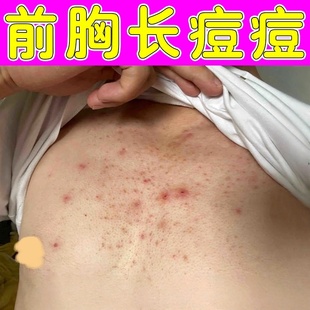 前胸后背长痘痘去除胸前痘痘毛囊全身长红疙瘩脓包软膏
