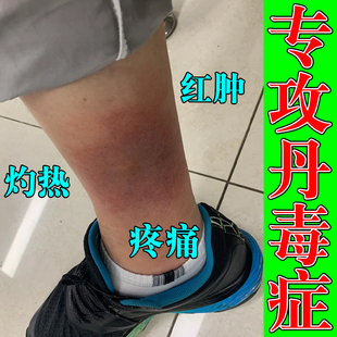 小腿丹毒皮肤红肿发热下肢丹毒流火消肿疼痛感染痒修复专用软膏