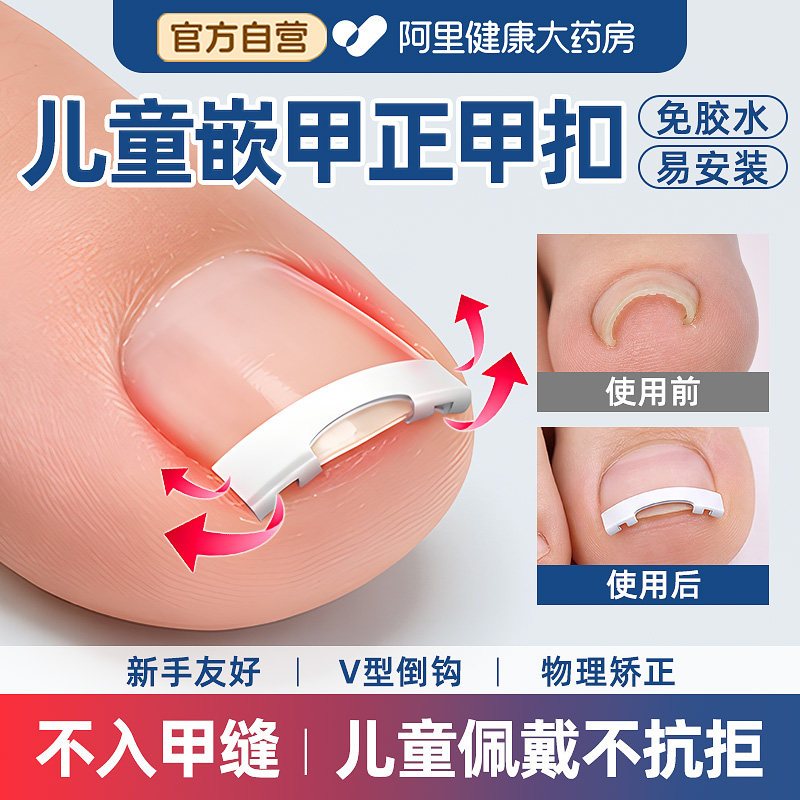 儿童甲沟矫正器嵌甲矫正器脚趾指甲纠正神器正甲扣专用炎正甲贴片