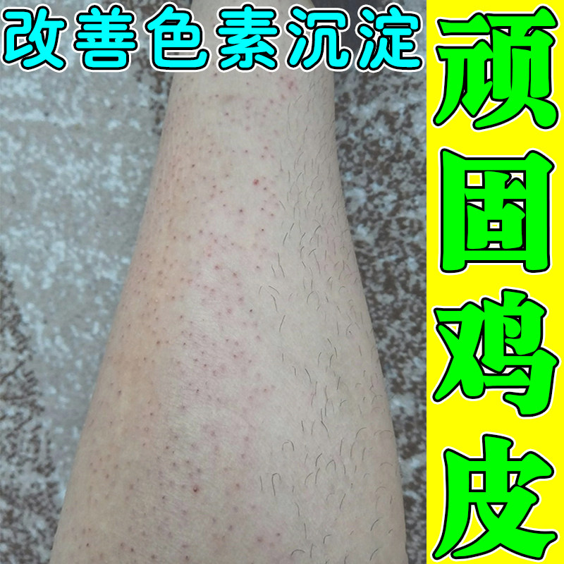 皮肤疙瘩毛囊角化儿童手臂脸上去除角质胳膊长凸起小疙瘩专用药