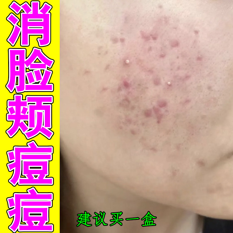 消脸颊痘痘额头痘下巴痘反复长脓包疙瘩小颗粒闭口粉刺熬夜上火痘