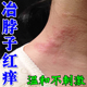 脖子上长红疙瘩皮肤过敏红痒刺挠颈部红斑疙瘩顽固干痒专用膏药乳