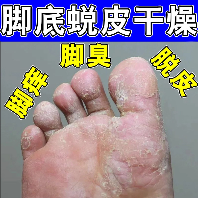 角化型脚臭脚趾开裂脱皮痒软膏