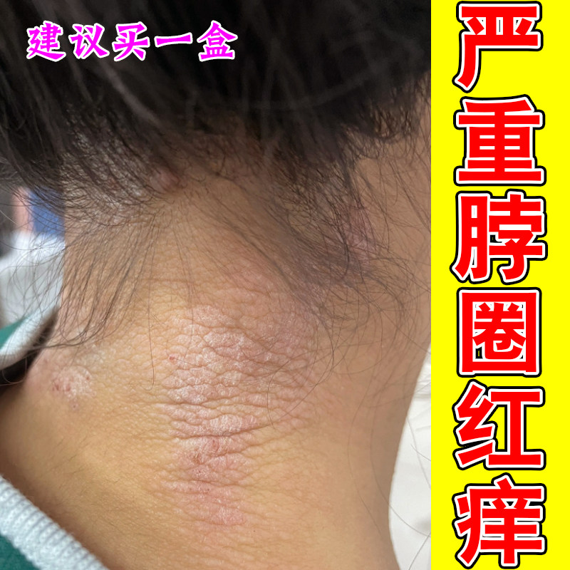 严重脖圈红痒皮肤干燥红肿起疹子起鳞屑神经性紫外线过敏专用修复