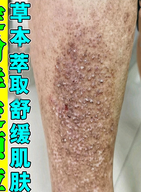 冶褐色疙瘩专用除斑状粗糙颗粒状蛋白物改善皮肤黑色素沉淀