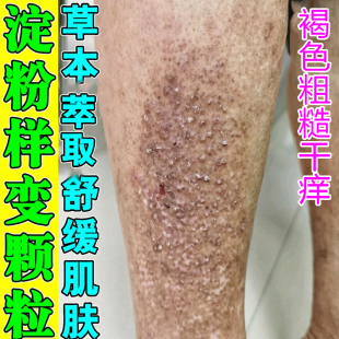 冶褐色疙瘩专用除斑状粗糙颗粒状蛋白物改善皮肤黑色素沉淀
