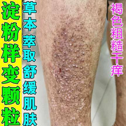 冶褐色疙瘩专用除斑状粗糙颗粒状蛋白物改善皮肤黑色素沉淀