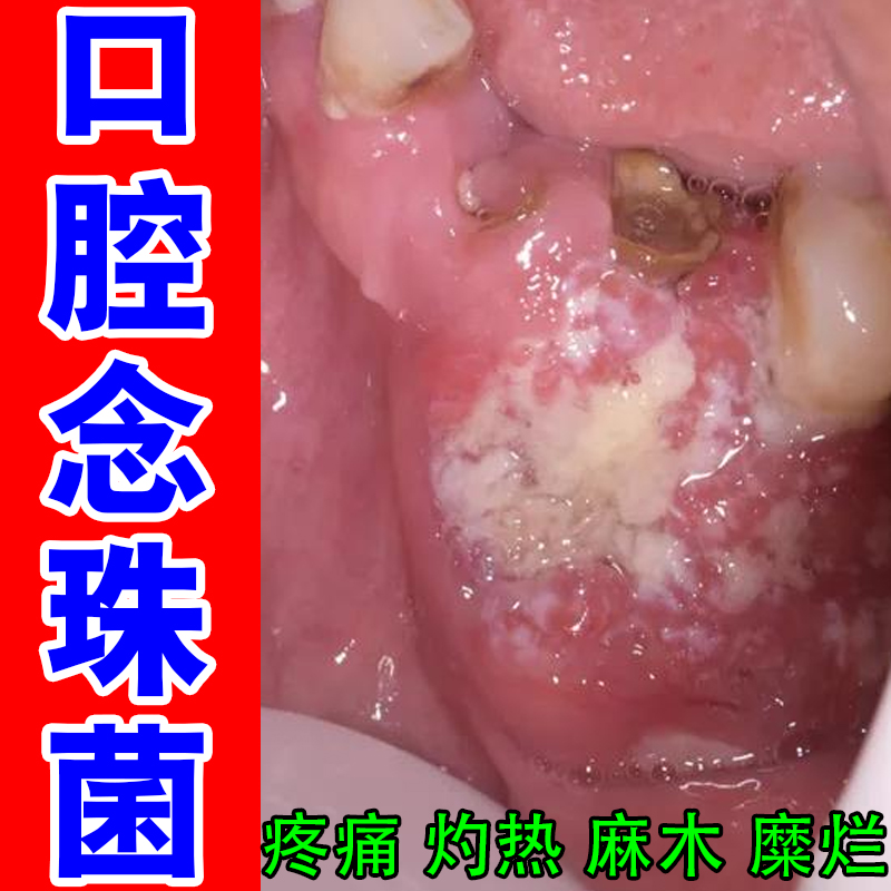 口腔念珠菌黏膜白斑扁平两边白斑溃烂口腔异味难闻灼痛上火长水泡