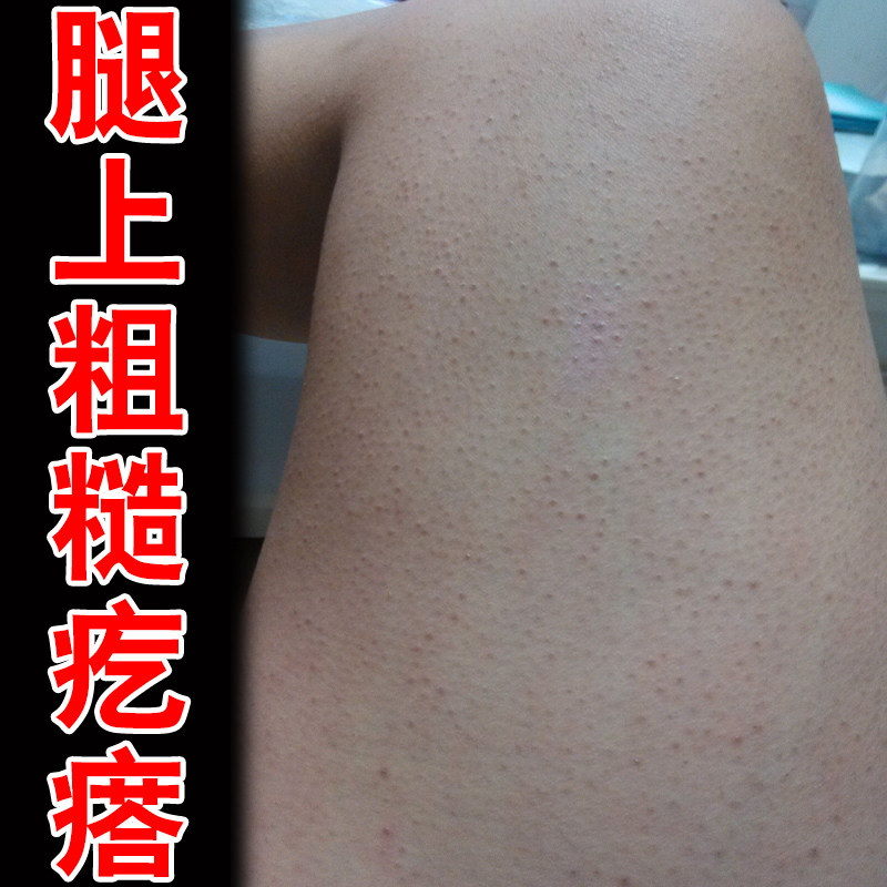 腿上粗糙疙瘩身上起小颗粒毛囊堵塞粗糙毛孔粗大专用皮肤干燥修护