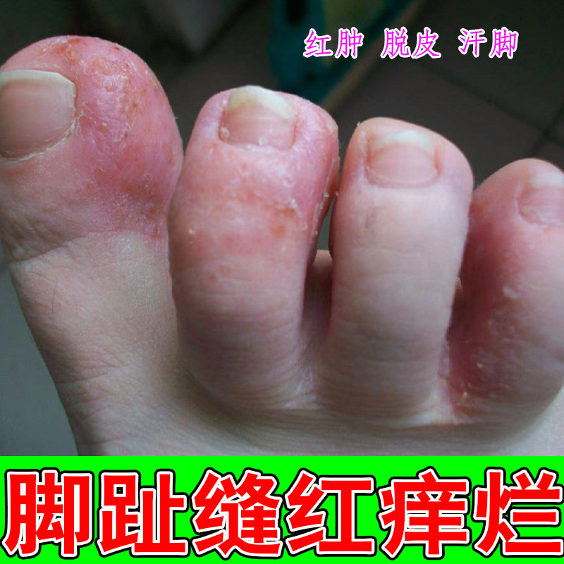 脚趾缝红痒脚底心痒窝状角质松懈症粗糙刺挠痒出汗脱皮痒专用