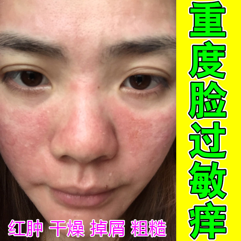 脸干燥起皮嘴角脸颊有碎屑修复药