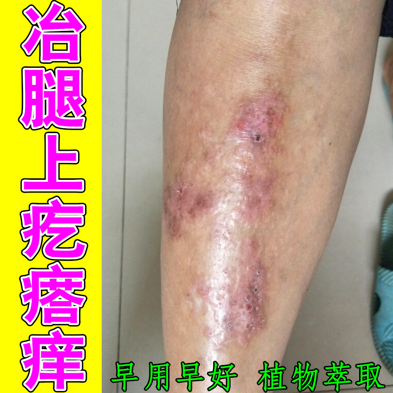 冶腿上疙瘩痒干燥起皮长红斑起硬疙瘩痘长红点疹子外用修护药乳膏