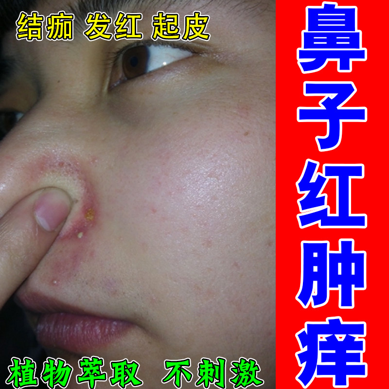 鼻翼脂溢鼻周泛红粗糙起皮药乳