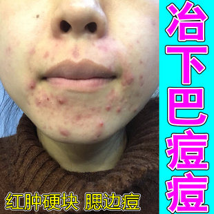 去下巴痘额头痘闭口粉刺的克星玫瑰坐疮上火熬夜脸上长硬疙瘩红肿