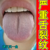 舌苔白厚有裂纹灼口综合症口腔麻木地图舌齿痕舌舌头裂纹舌面萎缩