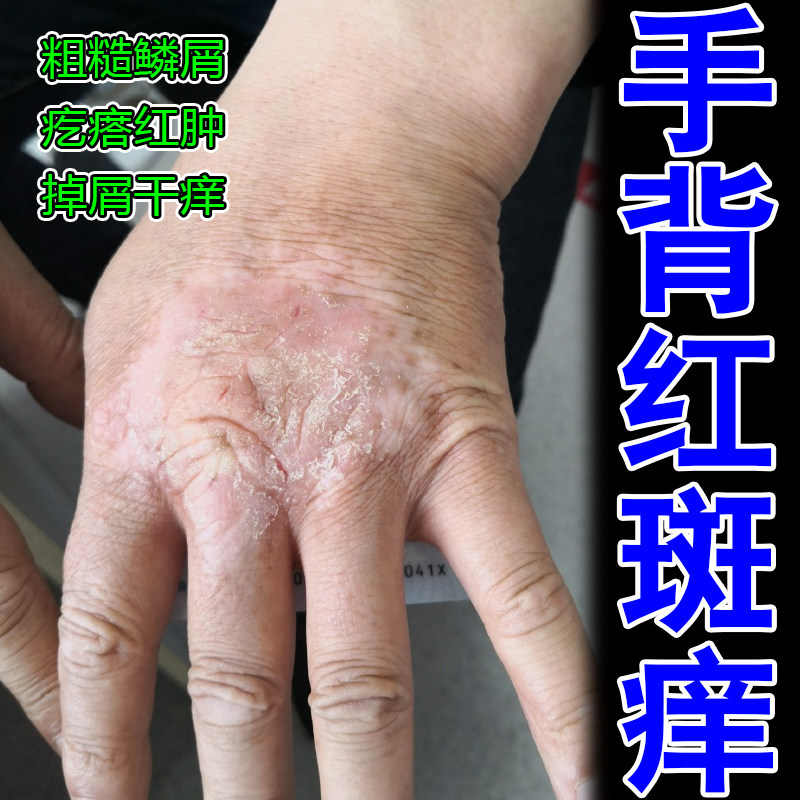 手背长红斑痒染粗糙鳞屑疙瘩红肿起鳞屑干痒手裂口专用修复