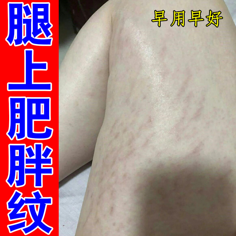 腿上肥胖纹生长纹腰腹上妊娠纹女人专用冶青少年腿上胳膊膨胀纹膏