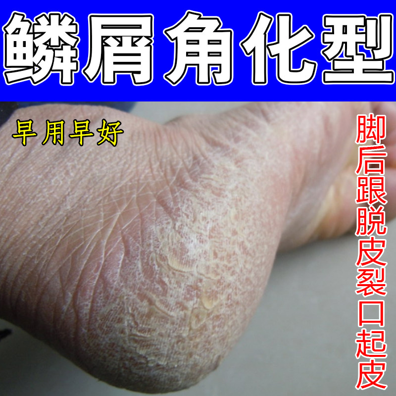 鳞屑角化型角质层增厚脚后跟干裂起硬皮足跟开裂脚部干燥粗糙掉屑