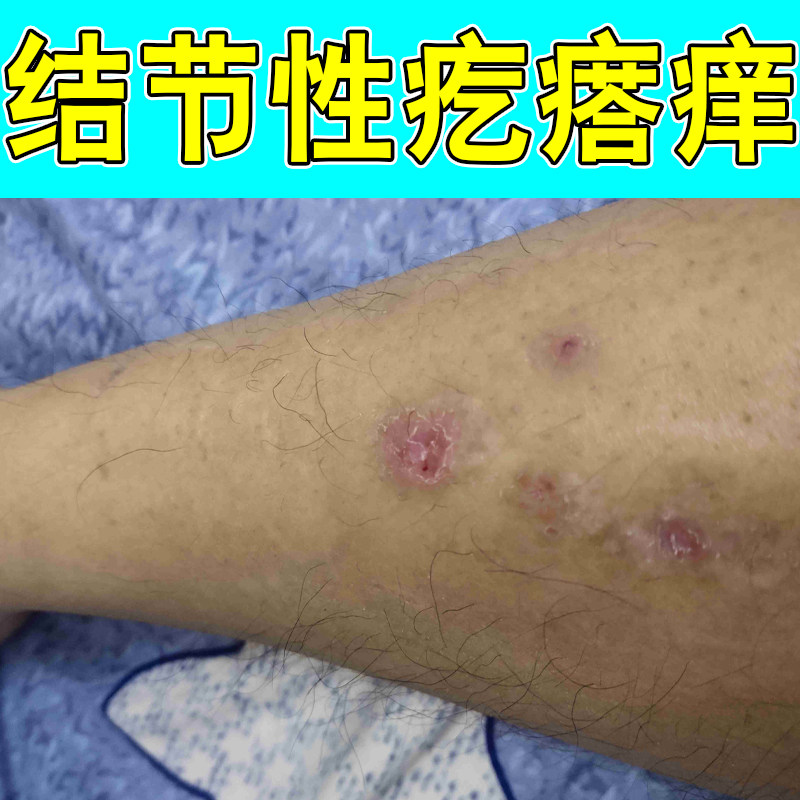结节性疙瘩痒身上起红疙瘩掉屑长痘硬块起皮结痂长红斑修护保湿药