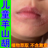 儿童羊山胡嘴唇周围起水泡痒痛经常舔嘴唇干燥粗糙脱皮掉屑修复膏